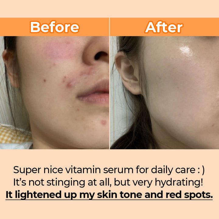 numbuzin - No.5 Goodbye Blemish Serum