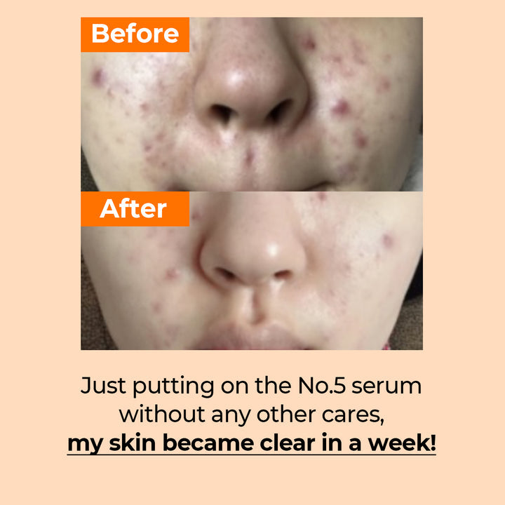 numbuzin - No.5 Goodbye Blemish Serum